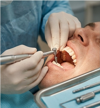 Dental Implants